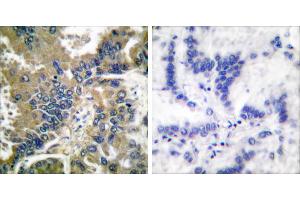 Cl-peptide - +Immunohistochemical analysis of paraffin-embedded human lung carcinoma tissue using Caspase 1 (Cleaved-Asp210) antibody. (Caspase 1 Antikörper  (Cleaved-Asp210))