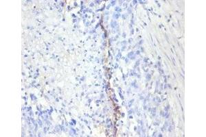 Immunohistochemistry of paraffin-embedded human bladder cancer using ABIN7164742 at dilution of 1:100 (Ki-67 Antikörper  (AA 3120-3256))