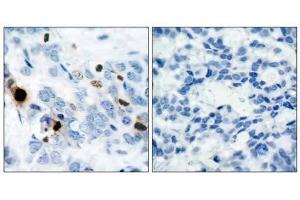 Immunohistochemical analysis of paraffin-embedded human breast carcinoma tissue using Histone H3. (Histone H3.1 Antikörper  (pSer10))