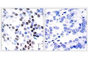 Immunohistochemical analysis of paraffin-embedded human breast carcinoma tissue using c-Jun (Ab-93) antibody (E021022). (C-JUN Antikörper)