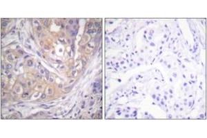 Immunohistochemistry analysis of paraffin-embedded human breast carcinoma, using Lck (Phospho-Tyr505) Antibody. (LCK Antikörper  (pTyr505))