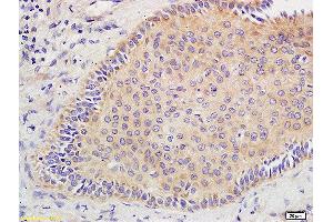 Formalin-fixed and paraffin embedded human oral squamous cell carcinoma tissue labeled with Anti CD44V10 Polyclonal Antibody, Unconjugated  at 1:400 followed by conjugation to the secondary antibody and DAB staining. (CD44v10 (AA 218-227) Antikörper)