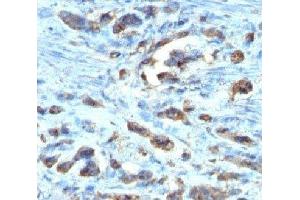 IHC testing of FFPE gastric carcinoma with Cdc20 antibody (clone AR12) (CDC20 Antikörper)