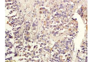 Formalin-fixed and paraffin embedded human colon carcinoma labeled with Anti-TGF-beta-2 Polyclonal Antibody, Unconjugated 1:300 followed by conjugation to the secondary antibody and DAB staining (TGF beta 2 Propeptide (AA 154-197) Antikörper)