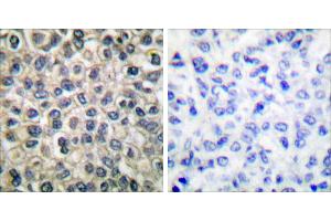 Peptide - +Immunohistochemical analysis of paraffin-embedded human breast carcinoma tissue using Catenin-γ antibody. (JUP Antikörper)