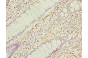 Immunohistochemistry of paraffin-embedded human colon cancer using ABIN7165941 at dilution of 1:100 (PPM1A Antikörper  (AA 1-382))