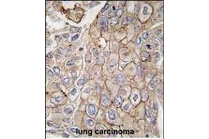 Formalin-fixed and paraffin-embedded human lung carcinoma tissue reacted with CLIC1 antibody, which was peroxidase-conjugated to the secondary antibody, followed by DAB staining. (CLIC1 Antikörper)