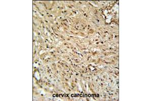 RPA43 Antibody immunohistochemistry analysis in formalin fixed and paraffin embedded human cervix carcinoma followed by peroxidase conjugation of the secondary antibody and DAB staining. (TWIST Neighbor Antikörper  (C-Term))