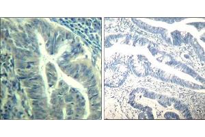 Immunohistochemical analysis of paraffin-embedded human colon carcinoma tissue using CDK6 (phospho-Tyr24) Antibody (E011543). (CDK6 Antikörper  (pTyr24))
