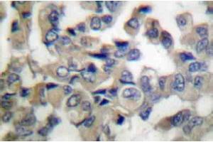 Immunohistochemistry Analysis: AP20201PU-N Synaptotagmin antibody staining of Paraffin-Embedded Human breast carcinoma tissue. (SYT1 Antikörper)