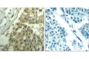 Immunohistochemical analysis of paraffin-embedded human breast carcinoma tissue using cdc2 (Ab-19) Antibody (E021529). (CDK1 Antikörper)