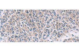 Immunohistochemistry of paraffin-embedded Human colorectal cancer tissue using PROKR2 Polyclonal Antibody at dilution of 1:40(x200) (Prokineticin Receptor 2 Antikörper)