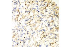 Immunohistochemistry of paraffin-embedded human kidney cancer using VANGL2 antibody (ABIN5975655) at dilution of 1/100 (40x lens). (VANGL2 Antikörper)