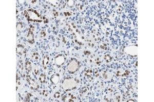 ABIN6267500 at 1/100 staining human Kidney carcinoma tissue sections by IHC-P. (BRCA1 Antikörper  (pSer1524))