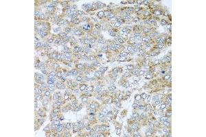 Immunohistochemistry of paraffin-embedded human liver cancer using NDUFA2 antibody (ABIN5974497) at dilution of 1/100 (40x lens). (NDUFA2 Antikörper)