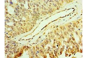 Immunohistochemistry of paraffin-embedded human endometrial cancer using ABIN7150705 at dilution of 1:100 (MAP2K3 Antikörper  (AA 1-170))