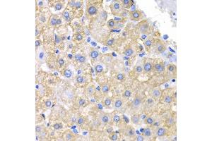 Immunohistochemistry of paraffin-embedded human liver cancer using CRK antibody (ABIN5975327) at dilution of 1/200 (40x lens). (Crk Antikörper)