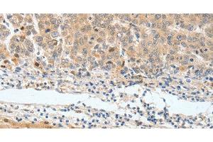 Immunohistochemistry of paraffin-embedded Human lung cancer tissue using BPIFB2 Polyclonal Antibody at dilution 1:45 (BPIL1 Antikörper)