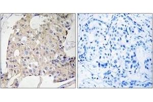Immunohistochemistry analysis of paraffin-embedded human breast carcinoma tissue, using NDRG3 Antibody. (NDRG3 Antikörper  (AA 206-255))