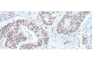 Immunohistochemistry of paraffin-embedded Human colorectal cancer tissue using HCRT Polyclonal Antibody at dilution of 1:25(x200) (Orexin Antikörper)
