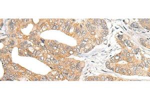 Immunohistochemistry of paraffin-embedded Human gastric cancer tissue using SNX6 Polyclonal Antibody at dilution of 1:40(x200) (SNX6 Antikörper)