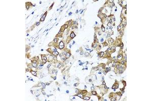 Immunohistochemistry of paraffin-embedded human colon carcinoma using PPOX antibody (ABIN5973799) at dilution of 1/100 (40x lens). (PPOX Antikörper)