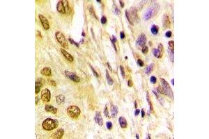 Immunohistochemical analysis of Histone H4 (AcK5) staining in human lung cancer formalin fixed paraffin embedded tissue section. (Histone H4 Antikörper  (acLys5, N-Term))