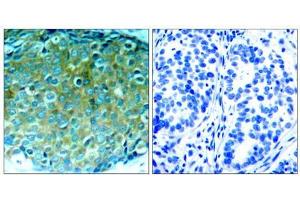 Immunohistochemical analysis of paraffin-embedded human breast carcinoma tissue, using PAK1 (Ab-212) antibody (E021160). (PAK1 Antikörper)