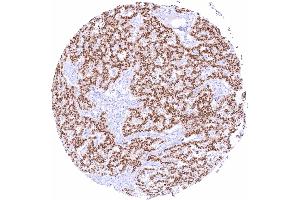 Pancreatic neuroendocrine tumor with strong predominantly nuclear Pax6 positivity of all tumor cells (PAX6 Antikörper)