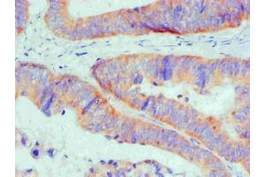 Immunohistochemical of paraffin-embedded Human Colon cancer tissue using ABIN7145293 at dilution of 1:200 (BCL2L1 Antikörper)