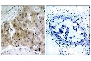 Immunohistochemical analysis of paraffin-embedded human breast carcinoma tissue, using V (VEGFR2/CD309 Antikörper  (pTyr1175))
