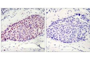 Immunohistochemical analysis of paraffin-embedded human breast carcinoma tissue using ATF-2 (Ab-112 or 94) antibody (E021033). (ATF2 Antikörper)