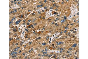 Immunohistochemistry of Human liver cancer using SULT1B1 Polyclonal Antibody at dilution of 1:30 (SULT1B1 Antikörper)