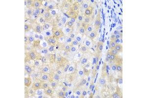 Immunohistochemistry of paraffin-embedded human liver cancer using FTH1 antibody at dilution of 1:100 (400x lens). (FTH1 Antikörper)