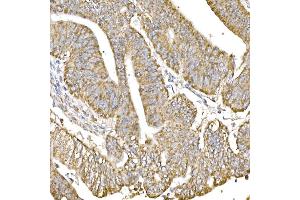 Immunohistochemistry of paraffin-embedded human colon carcinoma using GC1q R/C1QBP antibody (ABIN7266473) at dilution of 1:25 (40x lens). (C1QBP Antikörper)