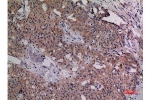 Immunohistochemical analysis of paraffin-embedded human-breast-cancer, antibody was diluted at 1:100. (IL-4 Antikörper  (Internal Region))