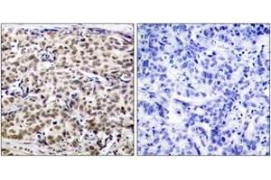 Immunohistochemistry analysis of paraffin-embedded human breast carcinoma tissue, using CREB (Ab-129) Antibody. (CREB1 Antikörper  (AA 96-145))