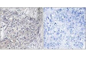 Immunohistochemistry analysis of paraffin-embedded human breast carcinoma, using 4E-BP1 (Phospho-Thr45) Antibody. (eIF4EBP1 Antikörper  (pThr46))
