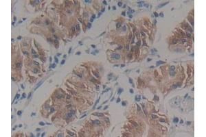 IHC-P analysis of Human Stomach cancer Tissue, with DAB staining. (HSD17B12 Antikörper  (AA 1-312))