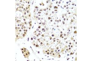 Immunohistochemistry of paraffin-embedded human colon carcinoma using TET2 antibody (ABIN6133019, ABIN6149017, ABIN6149019 and ABIN6221336) at dilution of 1:100 (40x lens). (TET2 Antikörper  (AA 1833-2002))