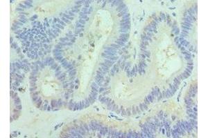 Immunohistochemistry of paraffin-embedded human colon cancer using ABIN7169126 at dilution of 1:100 (PAK1 Antikörper  (AA 1-240))