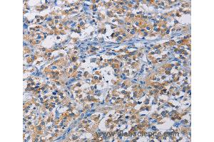 Immunohistochemistry of Human liver cancer using RICTOR Polyclonal Antibody at dilution of 1:50 (RICTOR Antikörper)