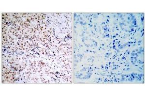 Immunohistochemical analysis of paraffin-embedded human breast carcinoma tissue, using Rb (phospho- Ser795) antibody (E011130). (Retinoblastoma 1 Antikörper  (pSer795))