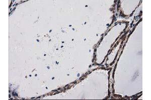 Immunohistochemical staining of paraffin-embedded Human thyroid tissue using anti-PRKCE mouse monoclonal antibody. (PKC epsilon Antikörper)