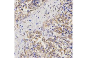 Immunohistochemistry of paraffin-embedded human lung cancer using TNFRSF1B antibody at dilution of 1:200 (x400 lens). (TNFRSF1B Antikörper)