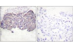 Immunohistochemistry analysis of paraffin-embedded human breast carcinoma, using HSL (Phospho-Ser552) Antibody. (LIPE Antikörper  (pSer552))